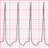 tachycardia