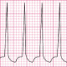tachycardia