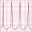 tachycardia